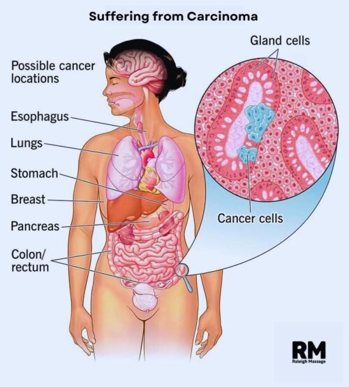 suffering from carcinoma